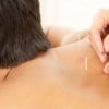 Acupuncture and Cupping for Enhanced Sports Recovery